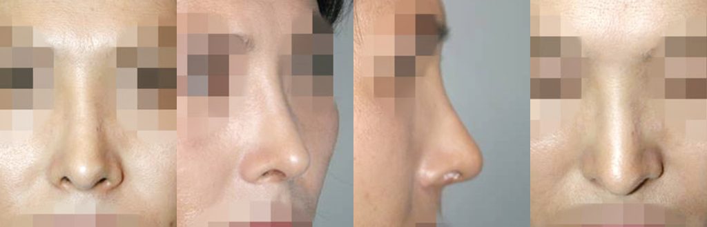 droopy nose rhinoplasty in korea