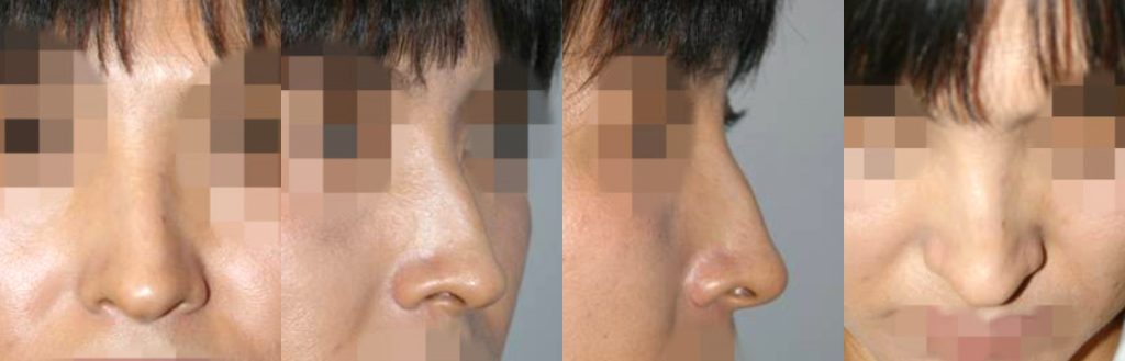 droopy nose rhinoplasty in korea