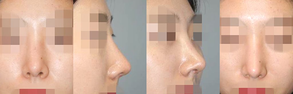 droopy nose rhinoplasty in korea