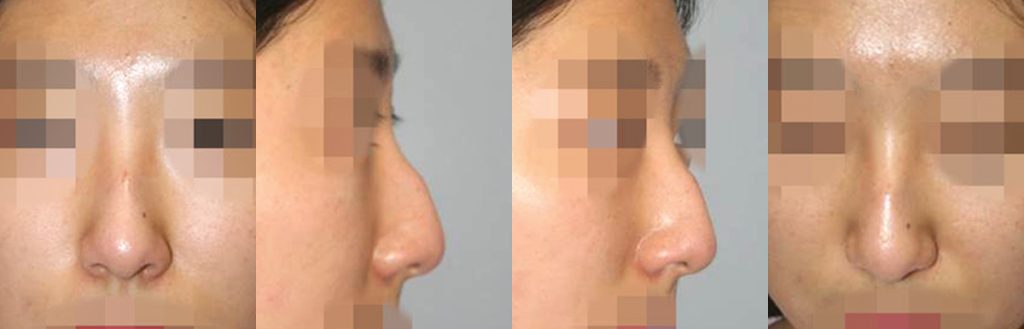 droopy nose rhinoplasty in korea