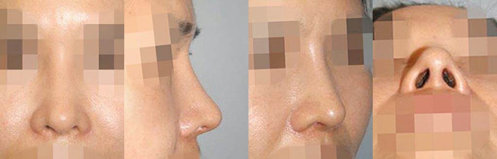 droopy nose rhinoplasty in korea