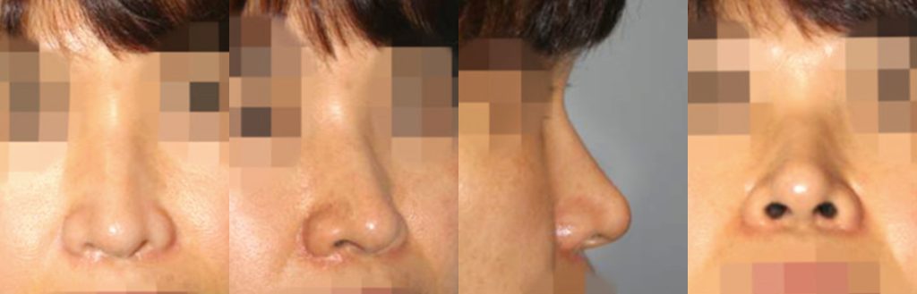 droopy nose rhinoplasty in korea