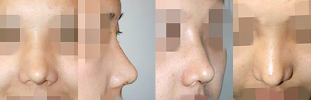 droopy nose rhinoplasty in korea