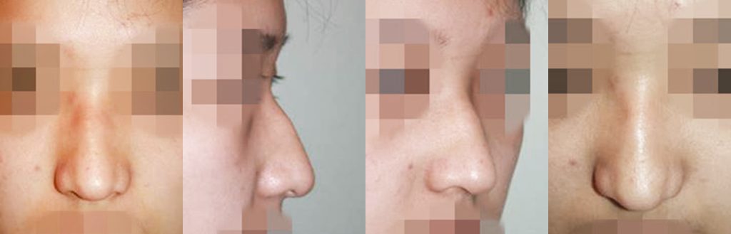 droopy nose rhinoplasty in korea