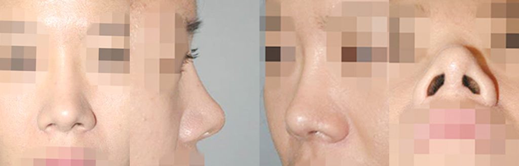 wide nose rhinoplasty in Korea