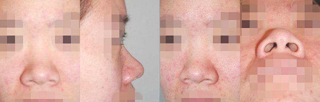 wide nose rhinoplasty in Korea