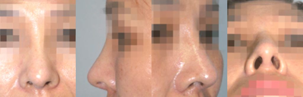 nasal bridge width correction rhinoplasty in korea