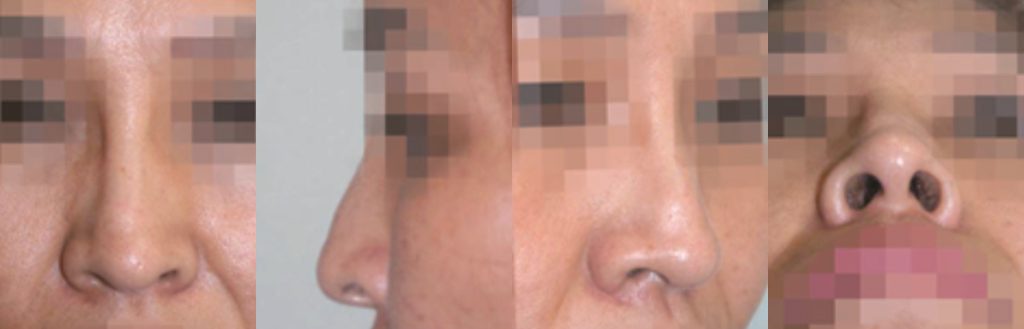 nasal bridge width correction rhinoplasty in korea