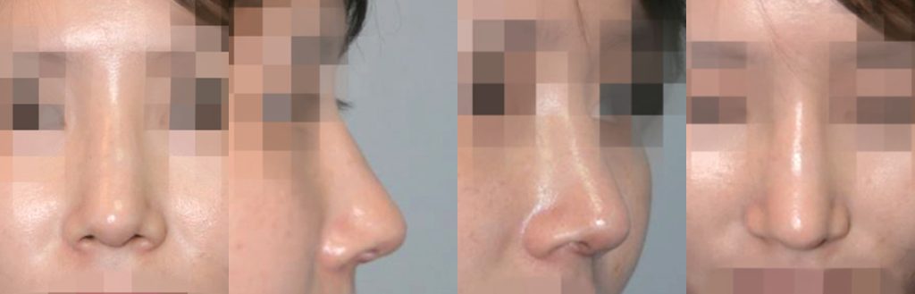 one stage multi-stage reconstructive rhinoplasty in korea