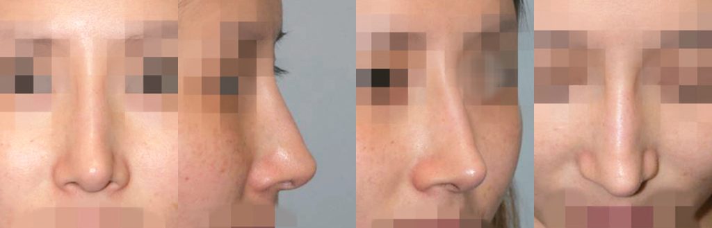 one stage multi-stage reconstructive rhinoplasty in korea