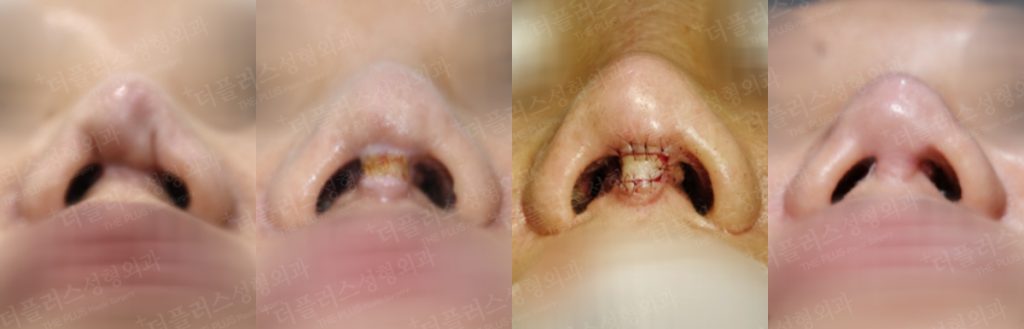 one stage multi-stage reconstructive rhinoplasty in korea