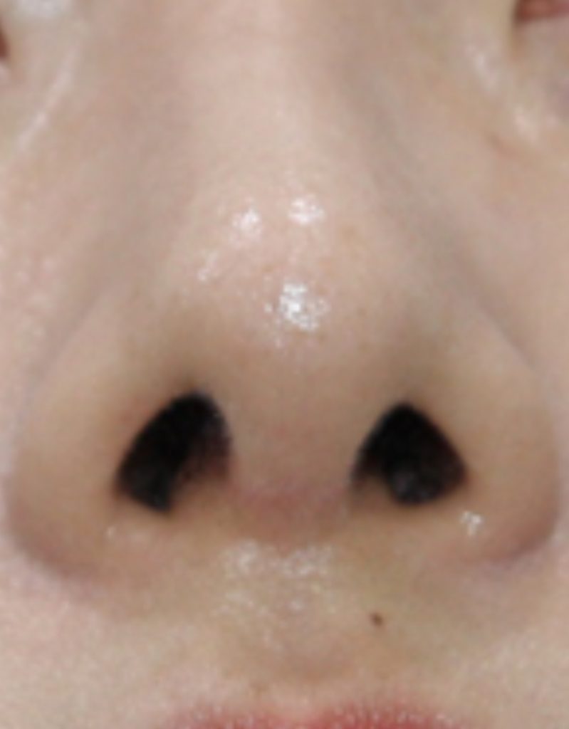 crooked nose revision rhinoplasty in korea