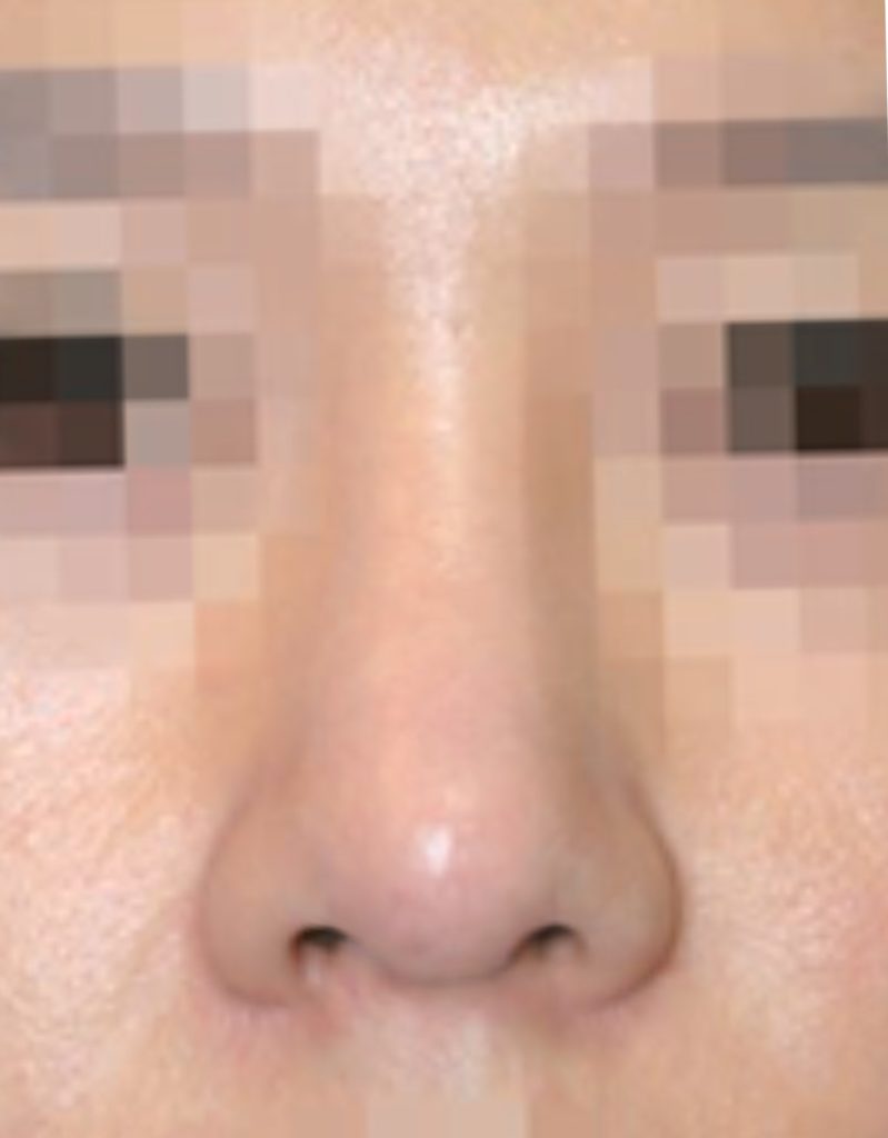 rosacea rhinoplasty in korea