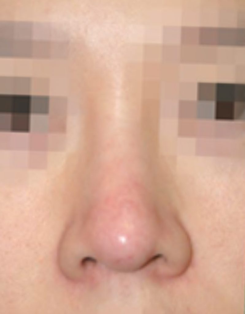 rosacea rhinoplasty in korea