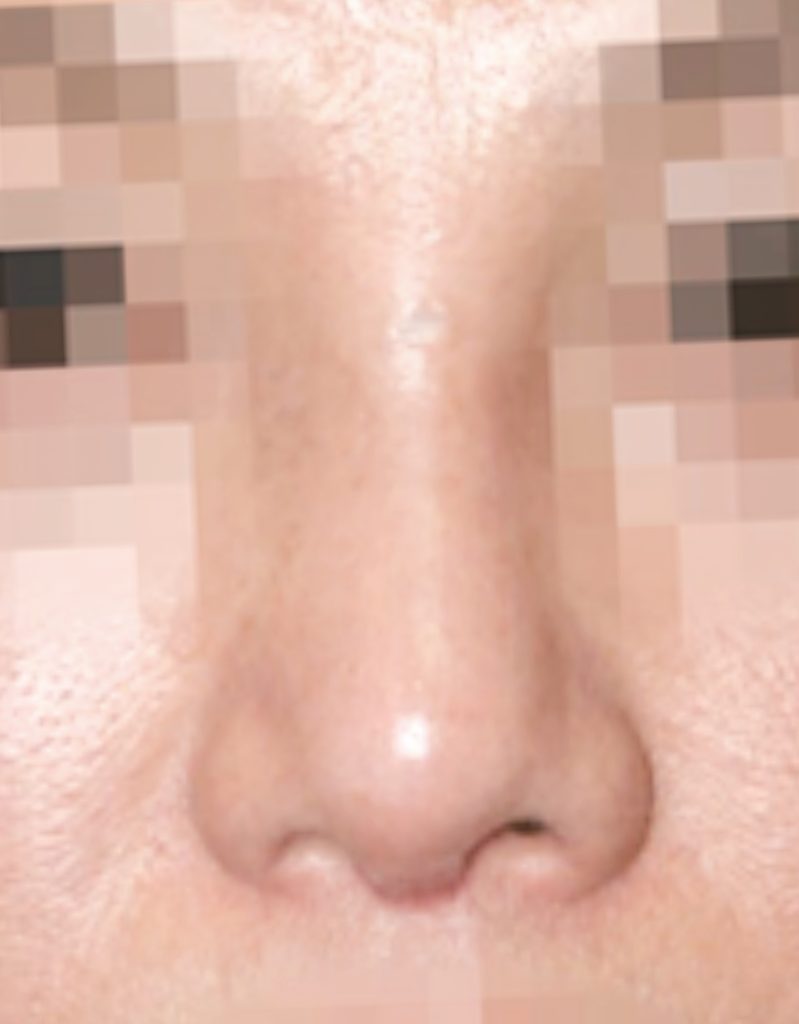 rosacea rhinoplasty in korea