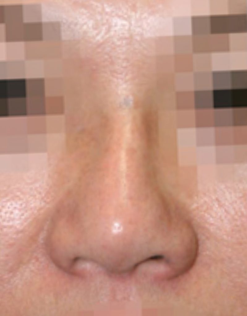 rosacea rhinoplasty in korea