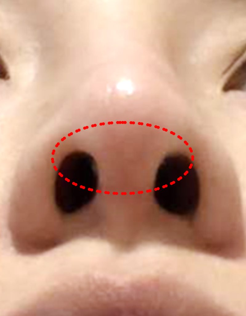 rhinoplasty scar treatment in korea