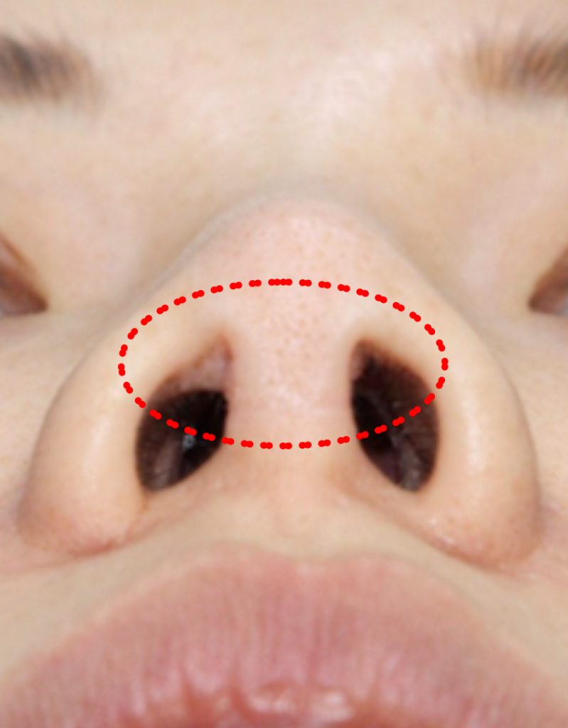 rhinoplasty scar treatment in korea