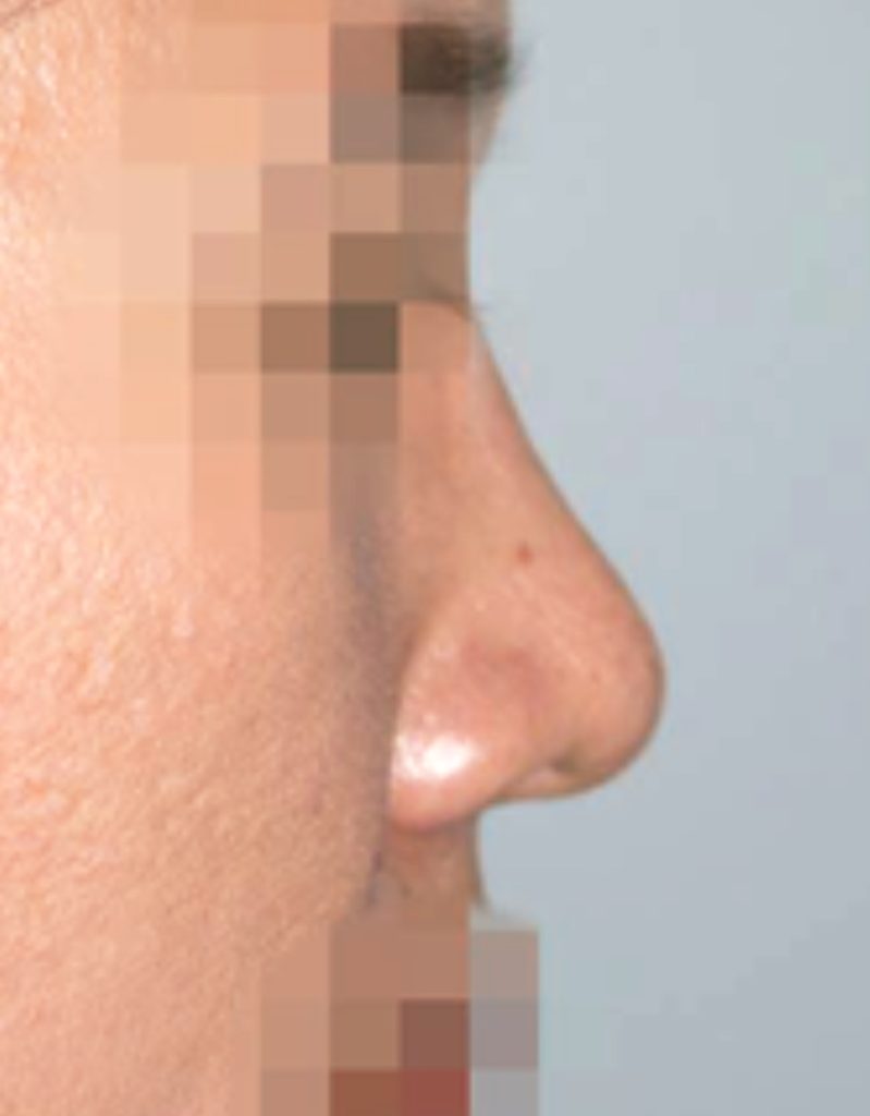 contracted nose revision rhinoplasty in korea