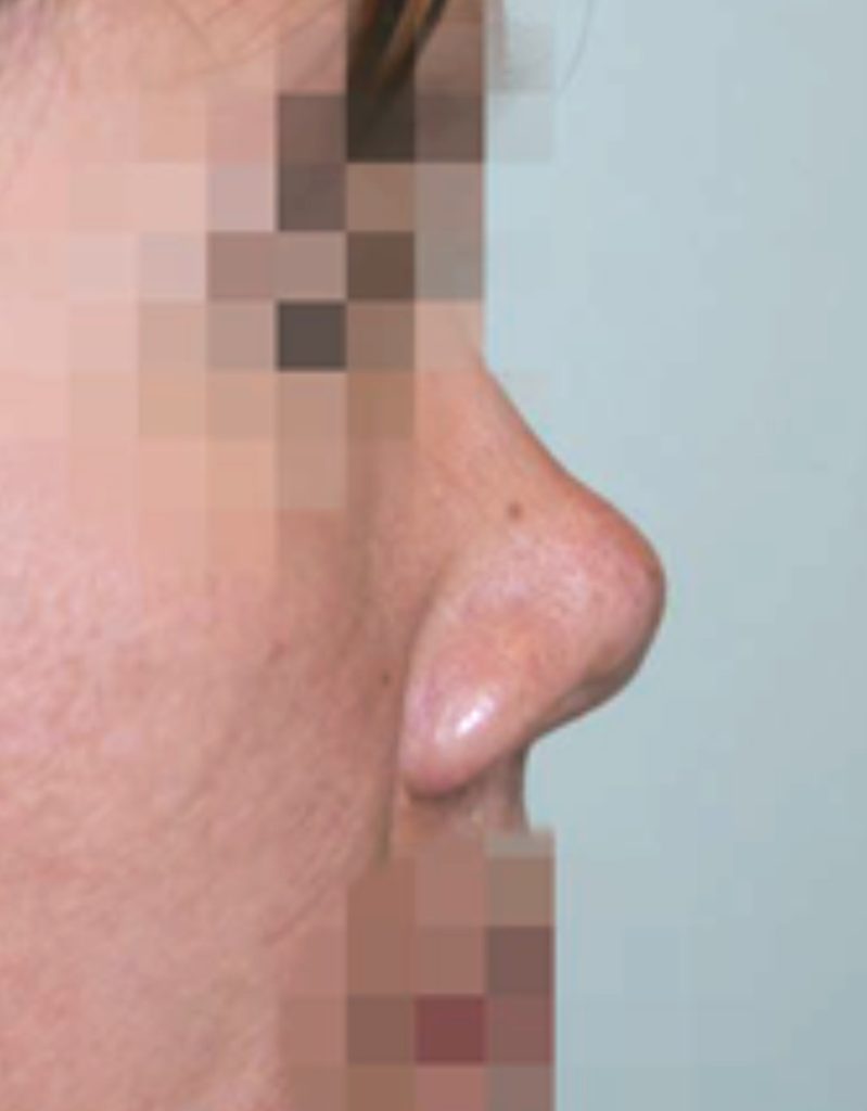 contracted nose revision rhinoplasty in korea