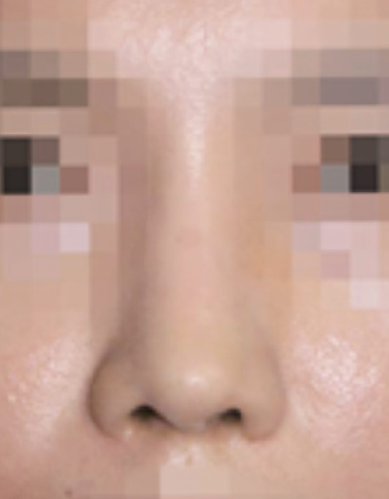 nasal bridge width correction rhinoplasty in korea