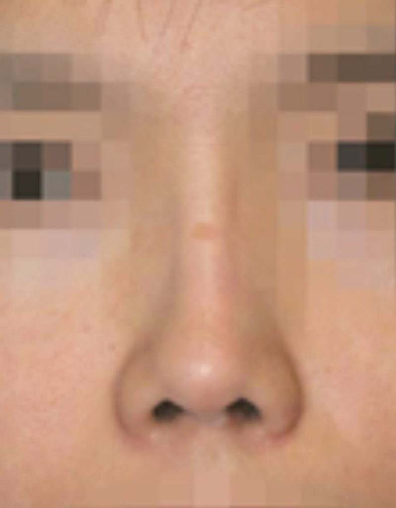 nasal bridge width correction rhinoplasty in korea