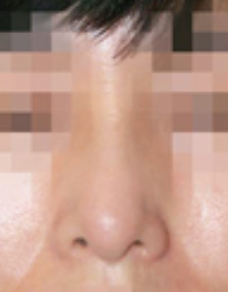 visible nose tip revision rhinoplasty in korea