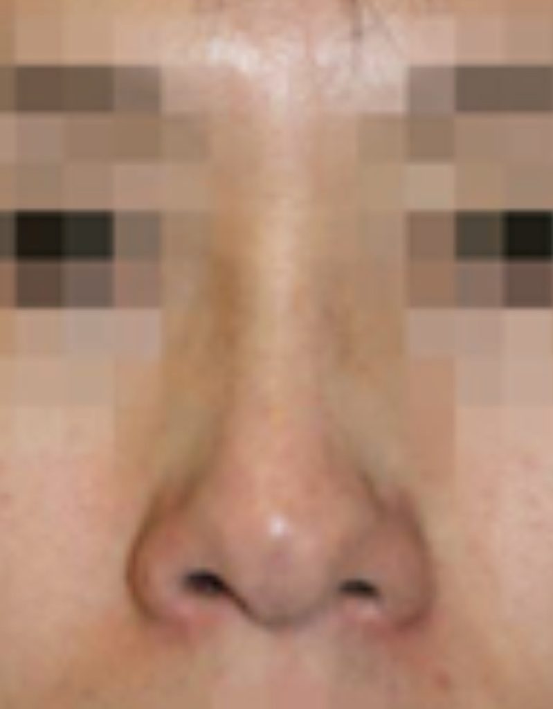 visible nose tip revision rhinoplasty in korea