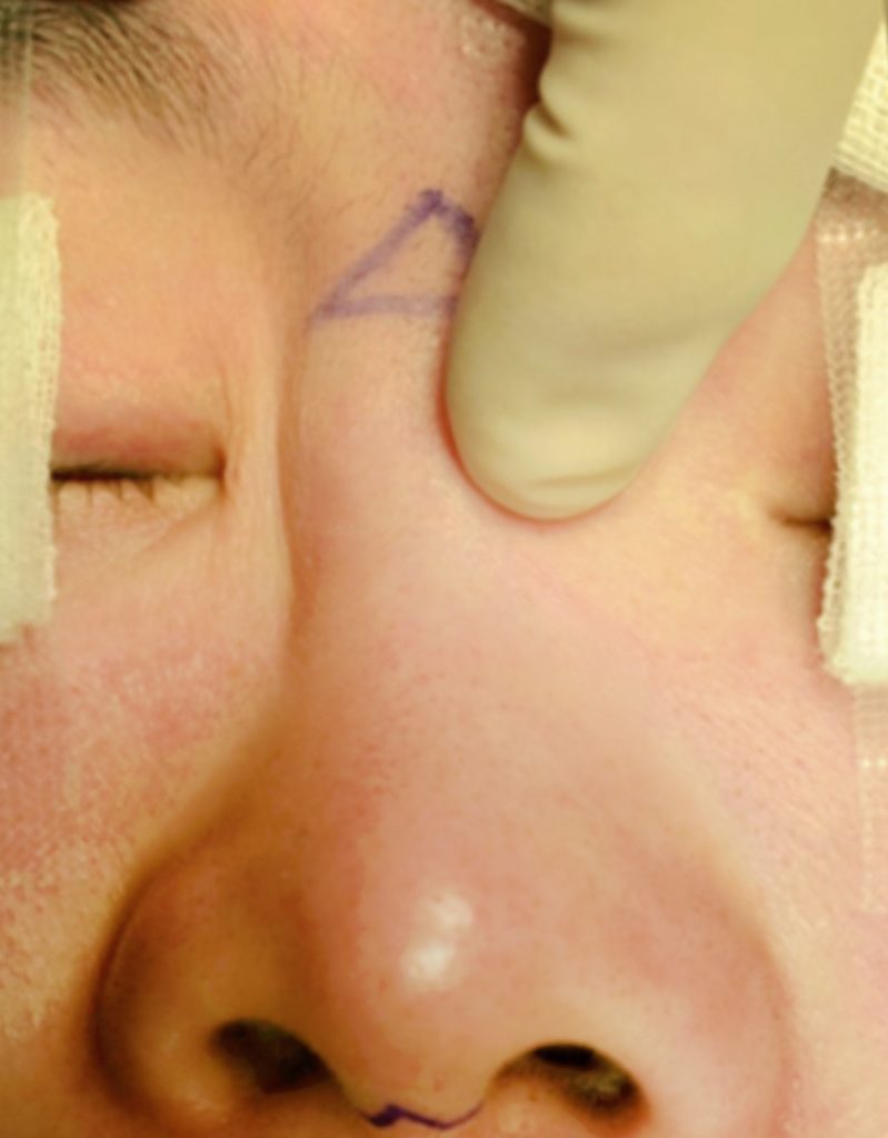 implant revision rhinoplasty in korea