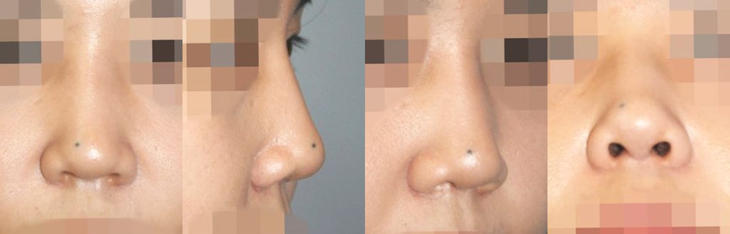 saddle nose reconstructive rhinoplasty in korea