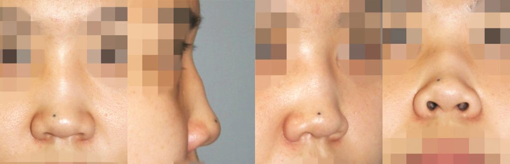 saddle nose reconstructive rhinoplasty in korea