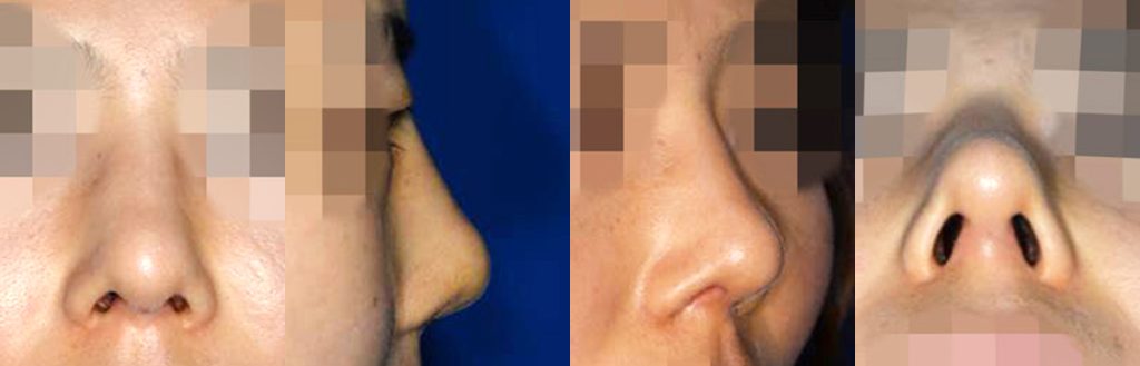 saddle nose reconstructive rhinoplasty in korea