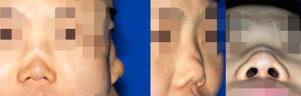 saddle nose reconstructive rhinoplasty in korea