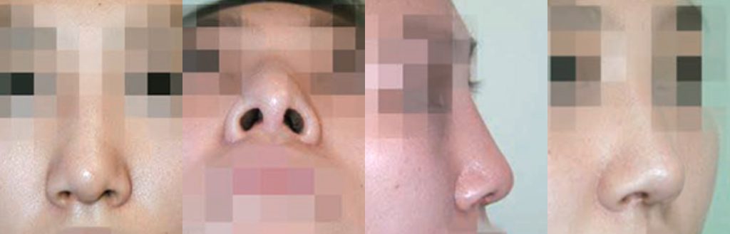 foreign body removal revision rhinoplasty in korea