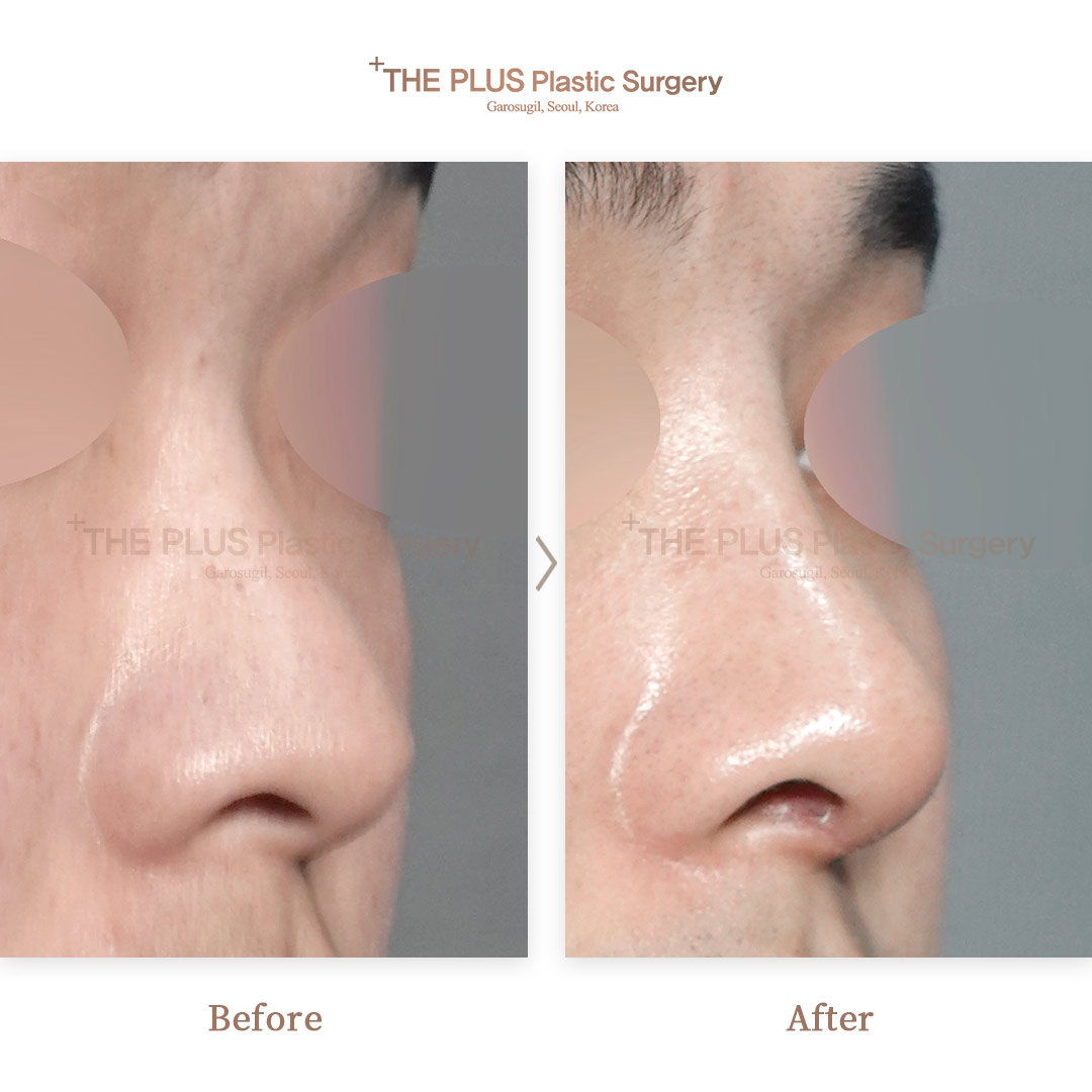 Facial Plastic Surgery Austin